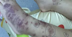 bệnh não mô cầu