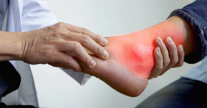 sai lầm điều trị bệnh gút