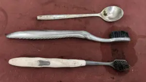 Bác sĩ lấy 2 bàn chải và một thìa inox ra khỏi dạ dày người bệnh, ca can thiệp giúp tránh biến chứng nguy hiểm.