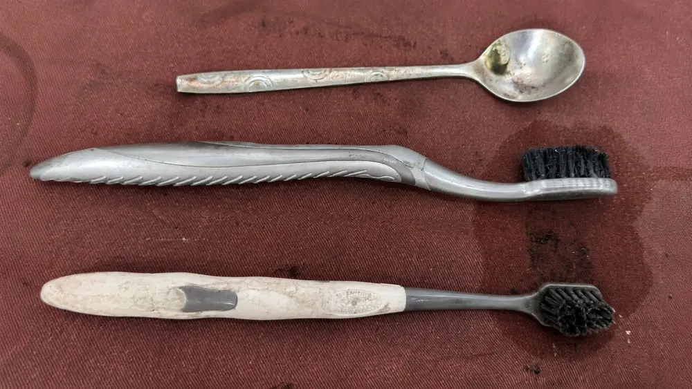 Bác sĩ lấy 2 bàn chải và một thìa inox ra khỏi dạ dày người bệnh, ca can thiệp giúp tránh biến chứng nguy hiểm.