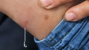 Giun rồng chui ra từ dưới da có thể gây đau đớn, loét da. Tìm hiểu dấu hiệu nhận biết và cách phòng bệnh hiệu quả.